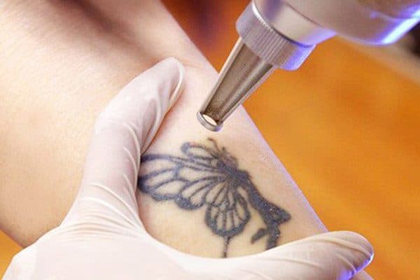 How Much Does Tattoo Removal Cost? A Comprehensive Guide to Pricing and Factors